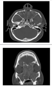 Allergic Fungal Sinusitis CT Scan