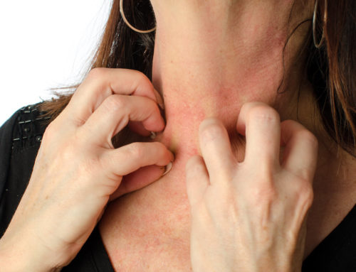 Stop the Itching! Testing Tells Why – Prurigo Nodularis