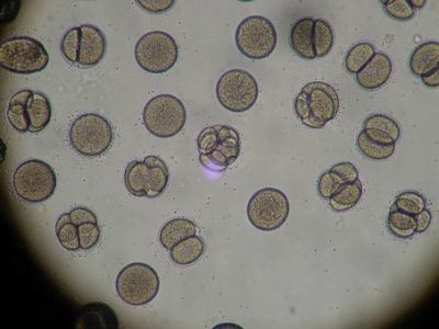 Pseudomonas Aeruginosa Biofilm DNA Analysis Chronic Sinusitis